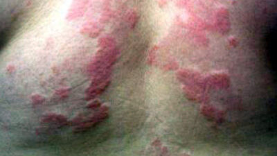 Egzama hastaları dikkat! Eğer hastalık ilerlerse...