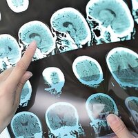 İşte korkulan hastalık MS'in belirtileri!