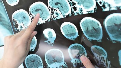 İşte korkulan hastalık MS'in belirtileri!