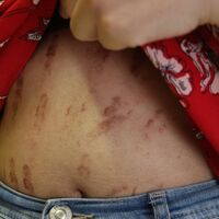 Epilasyona gitti, vücudu yanıklar içinde kaldı!