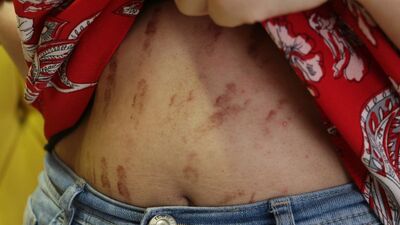 Epilasyona gitti, vücudu yanıklar içinde kaldı!