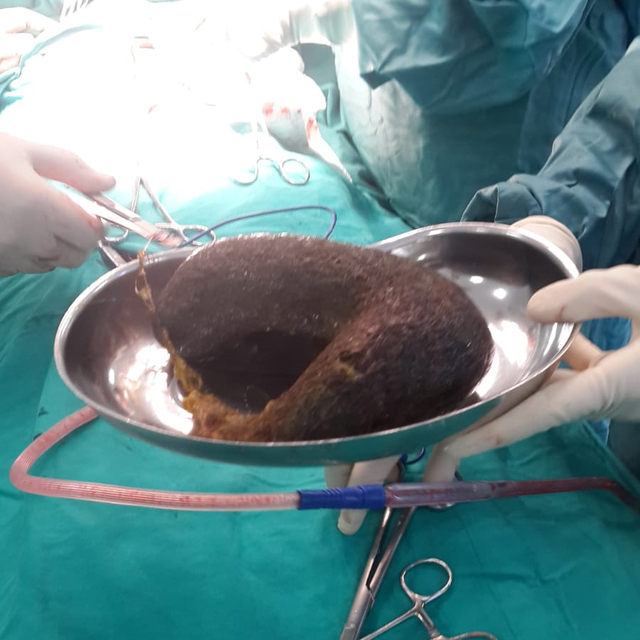 Mide ağrısı çekiyordu! Midesinden çıkanlar doktoru şok etti