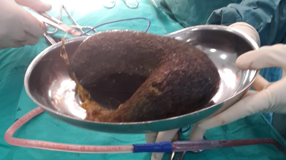 Mide ağrısı çekiyordu! Midesinden çıkanlar doktoru şok etti