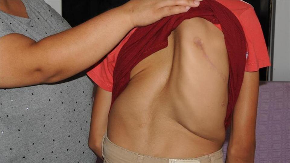 En çok kız çocuklarında görülüyor! Bu belirtilere dikkat!