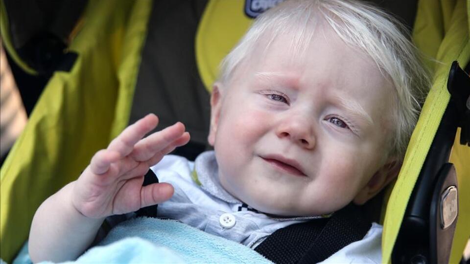 Cildinde, saçında, gözünde pigment yok! İşin kötüsü tedavisi de yok!