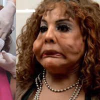 Yüzüne çimento enjekte ettirdi, bakın ne hale geldi...