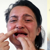 Beyaz diş uğruna 32 dişi çekilmişti, yetmedi! Şimdi ise...