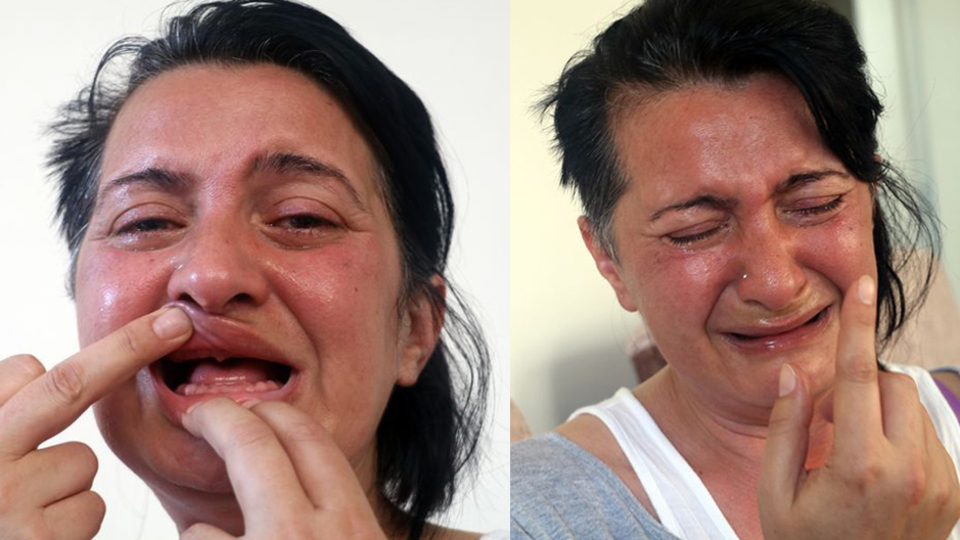 Beyaz diş uğruna 32 dişi çekilmişti, yetmedi! Şimdi ise...