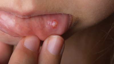 İşte ağız kanserinin belirtileri!