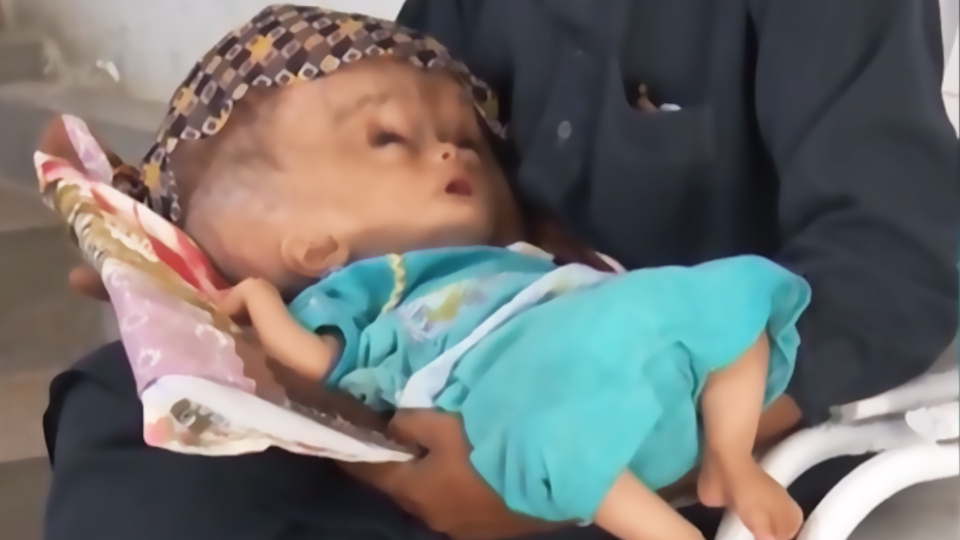 Talihsiz bebek böyle doğdu! Yemek yiyemiyor, uyuyamıyor!