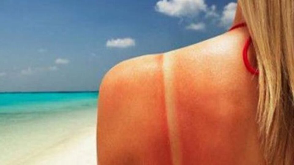 Güneş yanığına ne iyi gelir