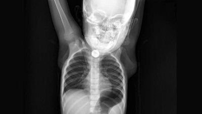 Yer Batman: 3 ay önce yuttuğu pil bakın neye sebep oldu...