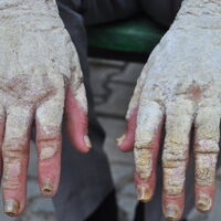 Sedef hastaları en çok bu sorunu yaşıyor!