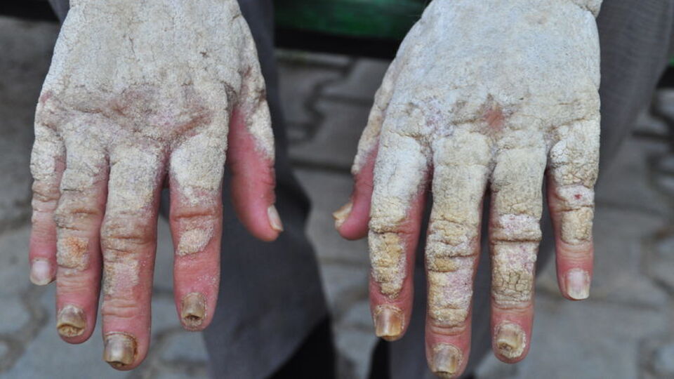 Sedef hastaları en çok bu sorunu yaşıyor!