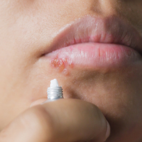 Uçuk Alzheimer mı yapıyor?