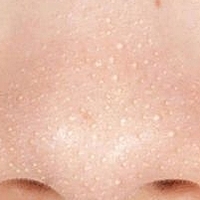 Birbirinden etkili siyah nokta maskesi tarifleri