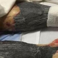 Et yiyen bakteri yüzünden hayatını kaybetti!