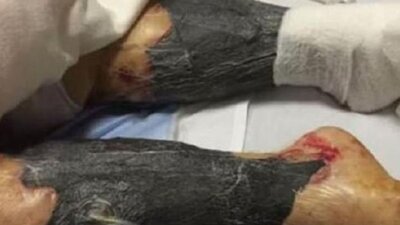 Et yiyen bakteri yüzünden hayatını kaybetti!