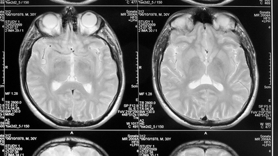Korkunç! Beyninde 100 tane kurt tespit ettiler!