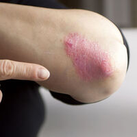 Sedef hastasının hayatını kolaylaştıracak tüyolar!