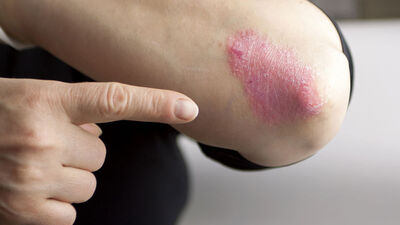 Sedef hastasının hayatını kolaylaştıracak tüyolar!