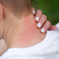 Sivrisinek ısırığına karşı mucize yağ!