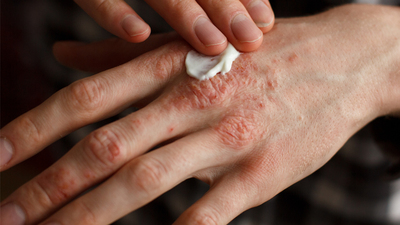 Sedef hastalığı tarih olabilir!