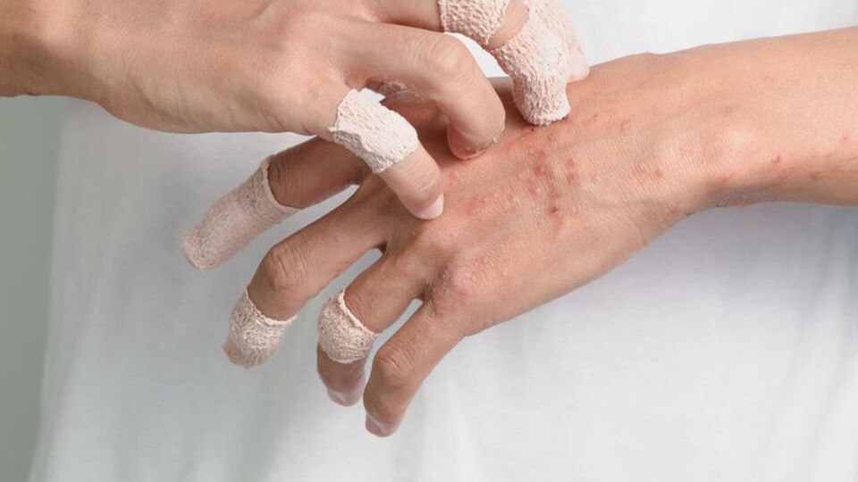 Egzamadan korunmak için 12 önlem!