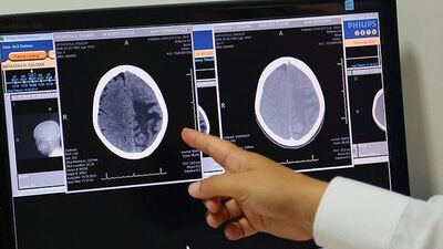 Beyin kanserinde hücrelerin sonsuz bölünmesinin önüne geçildi