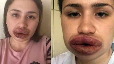 Bir Merve Hemşire vakası daha! Dudak estetiği için gitti ama...