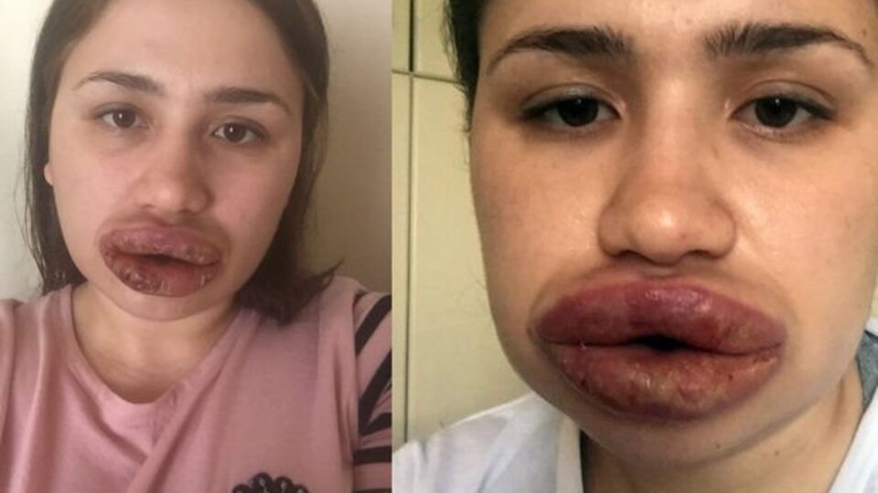 Bir Merve Hemşire vakası daha! Dudak estetiği için gitti ama...