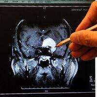 Geçmişi silen hastalık dünyada 47 milyon kişiyi etkiliyor!