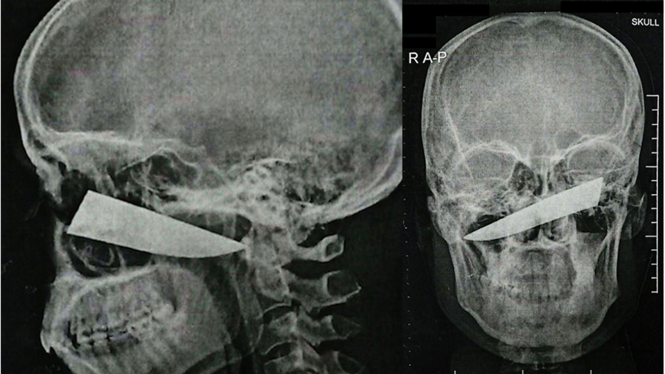 Tam 10 santimetre... Kafatasına saplanıp kaldı!