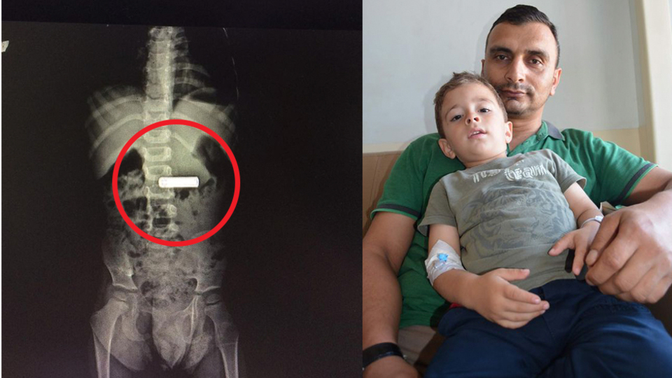 3 yaşındaki çocuğun röntgeni görenleri şaşkına çevirdi!