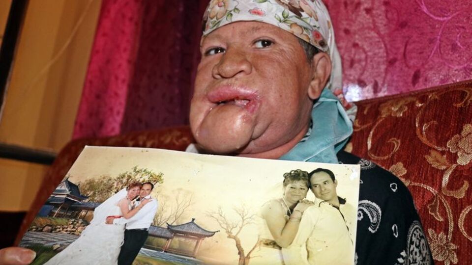 Çenesinde çıkan sivilceyi önemsemedi, hayatı karardı!