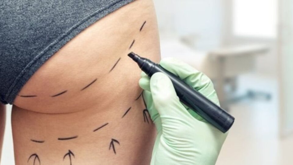 Brezilya kalçası operasyonunda bir İngiliz kadın daha öldü: 'Türkiye'de ameliyat oldum' diyenler anlatıyor