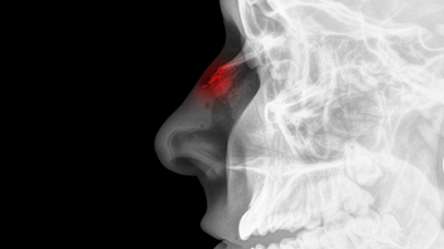 Burun kemiği kırıkları tam olarak ne zaman iyileşir?