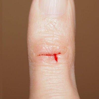 En büyük acılardan biri... Kağıt kesiği neden çok acıtır?