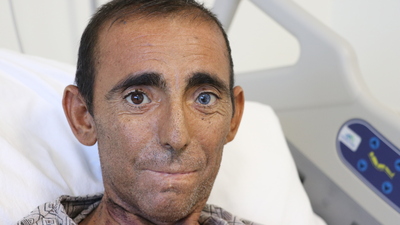 İnanması zor ama gerçek! Beşinci böbreğini karnında taşıyor!