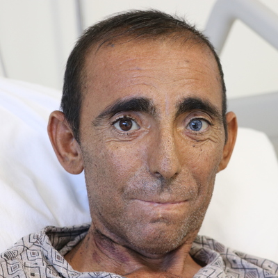 İnanması zor ama gerçek! Beşinci böbreğini karnında taşıyor!