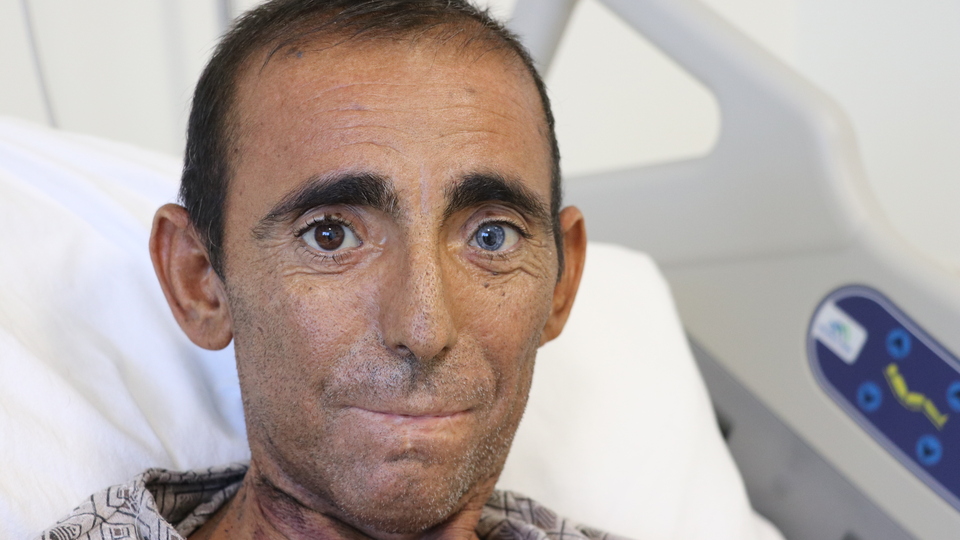 İnanması zor ama gerçek! Beşinci böbreğini karnında taşıyor!