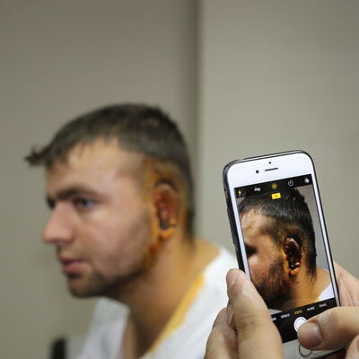 Kaburga kıkırdağından kulak yaptılar