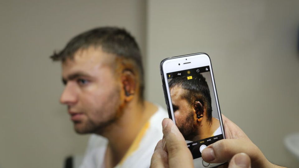 Kaburga kıkırdağından kulak yaptılar