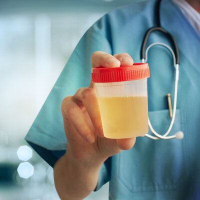 İdrar rengine dikkat! Kanser belirtisi olabilir...