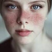 Lupus hastalığı nedir?