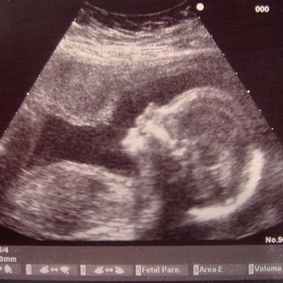 Tıp tarihinde bir ilk! Aynı bebeğe hamile kaldılar!