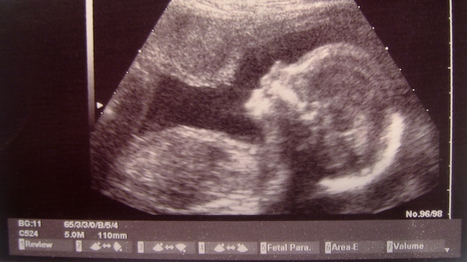 Tıp tarihinde bir ilk! Aynı bebeğe hamile kaldılar!