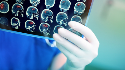 İnme geçiren hastalarda buna dikkat!