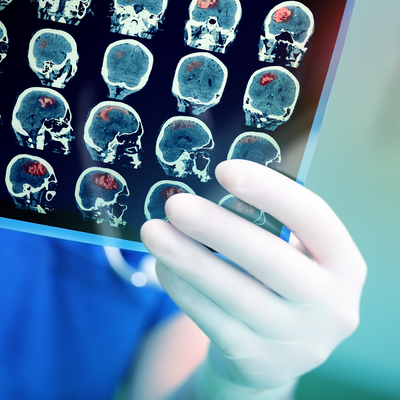 İnme geçiren hastalarda buna dikkat!