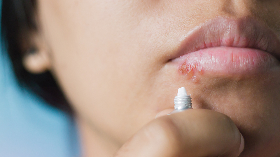 Dudakta uçuk, göğüste ağrı o hastalığa işaret!